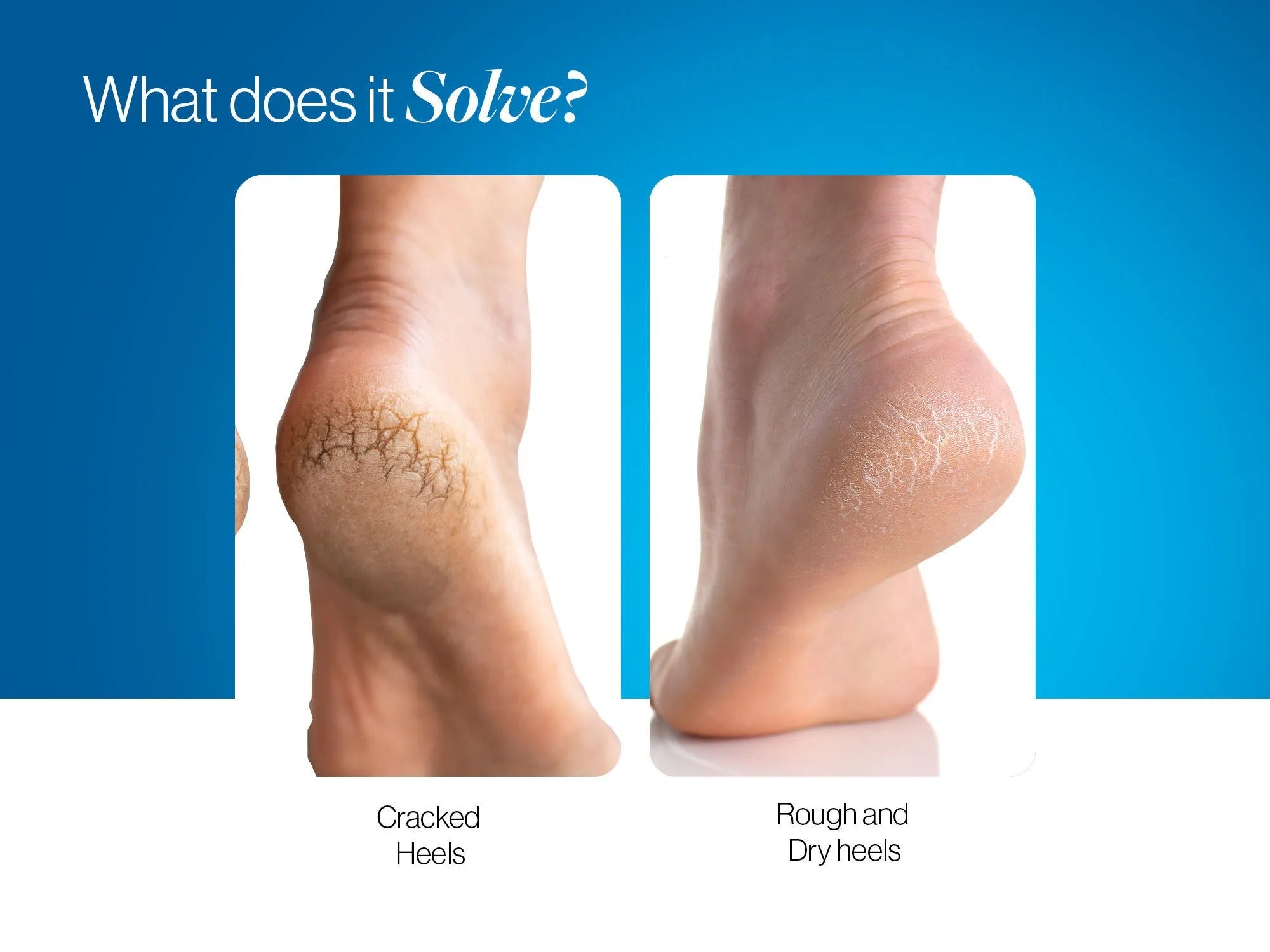 20% Urea Foot Roll On - 50 ml