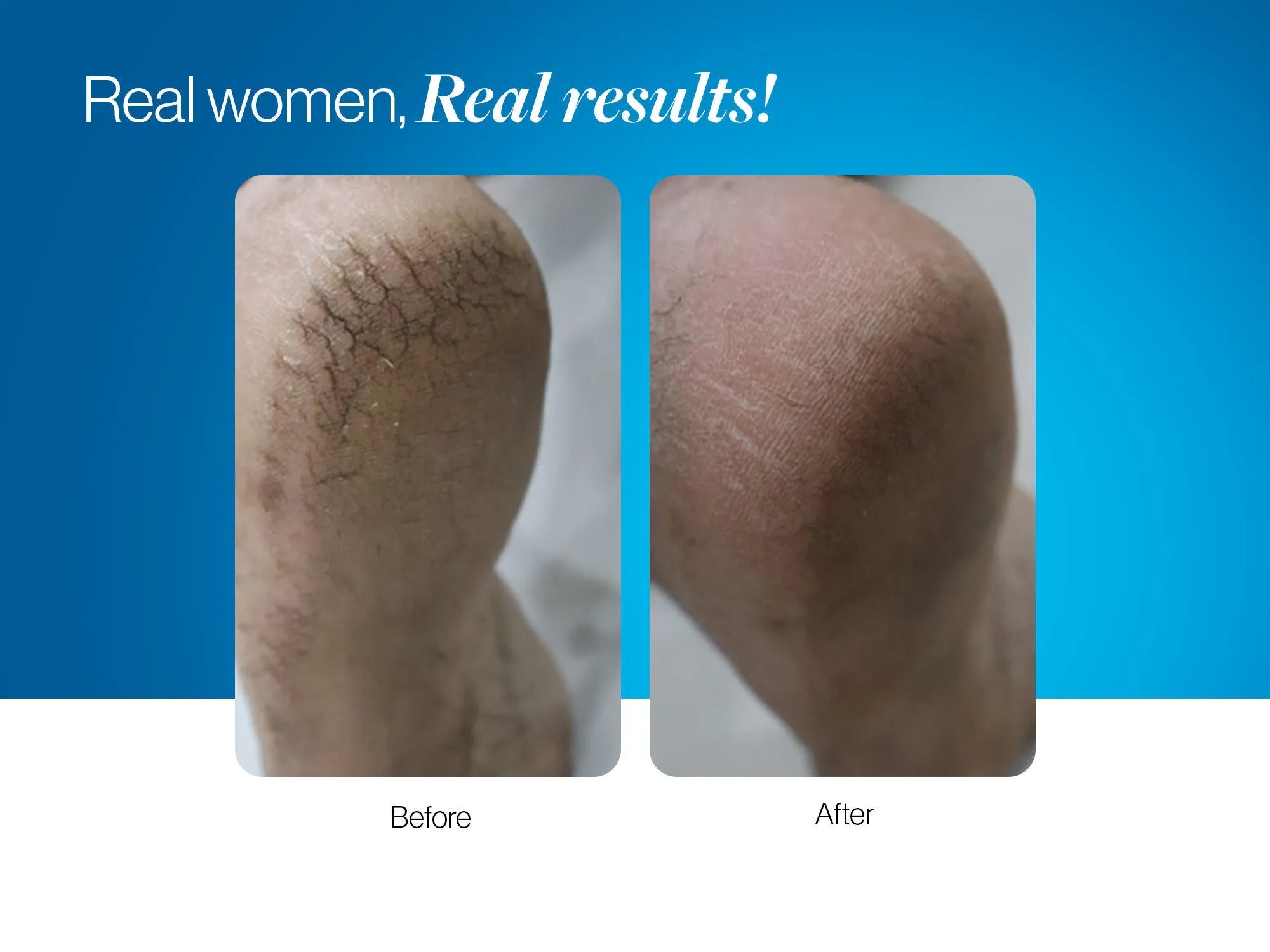 20% Urea Foot Roll On - 50 ml